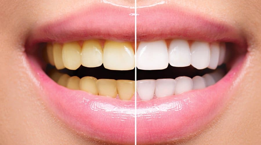 أسباب اصفرار الأسنان، طرق طبيعية للتخلص من اصفرار الأسنان، تبييض الأسنان ، طب الأسنان